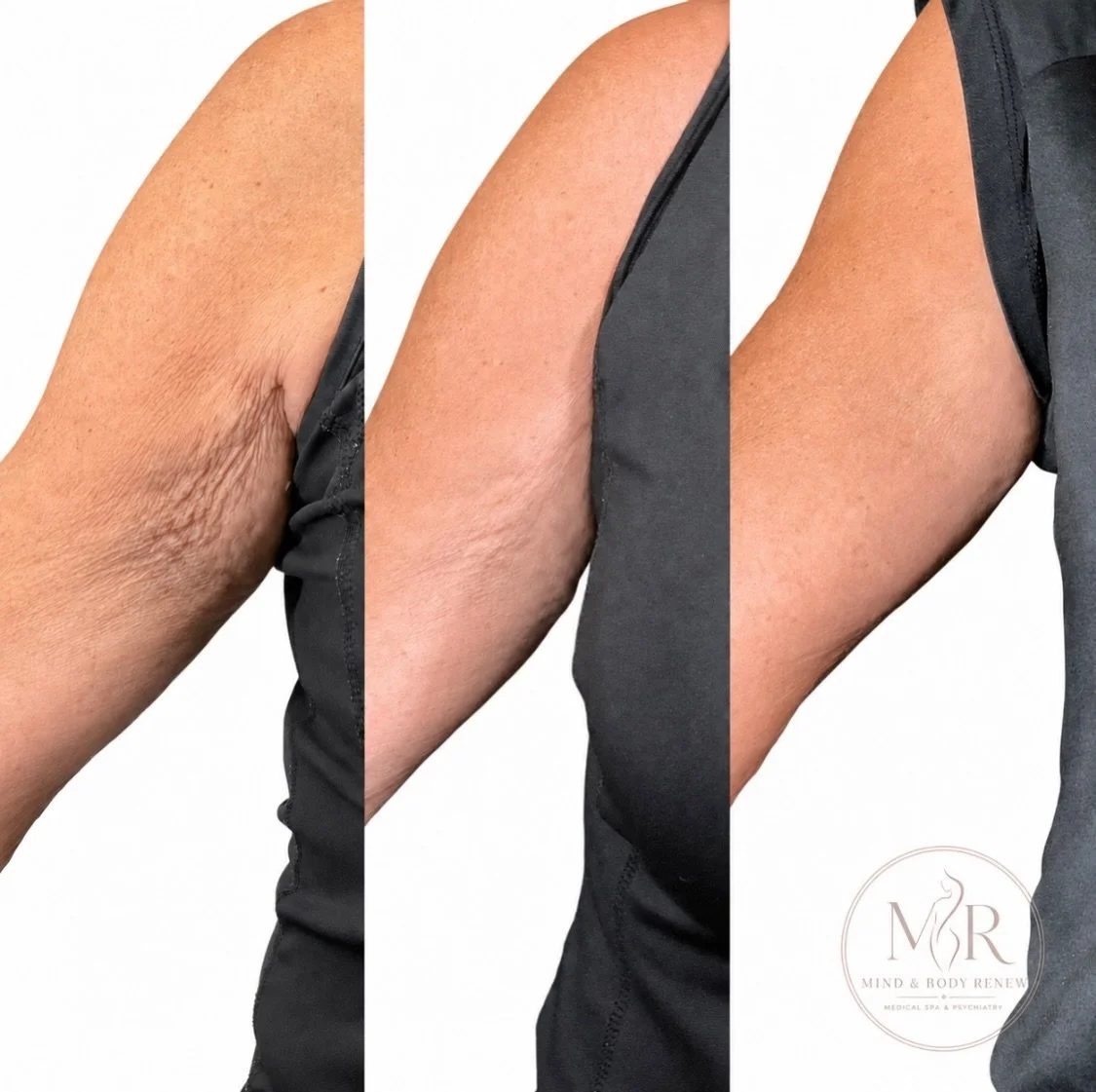 Smoother, firmer, more youthful-looking arms ✨ Arm rejuvenation is all about restoring confidence with results tailored to you. Ready to give your arms the refresh they deserve? Book your consultation today.

#ArmRejuvenation #BodyConfidence #Aesthet