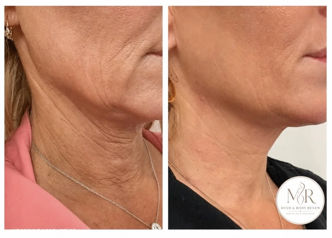 ✨ Renew your profile&mdash;without surgery. ✨

Our Double Chin, Neck &amp; D&eacute;collet&eacute; Eljte  Renewal Program is designed to contour beneath the chin, firm the neck, smooth visible lines, and rejuvenate delicate d&eacute;collet&eacute; sk