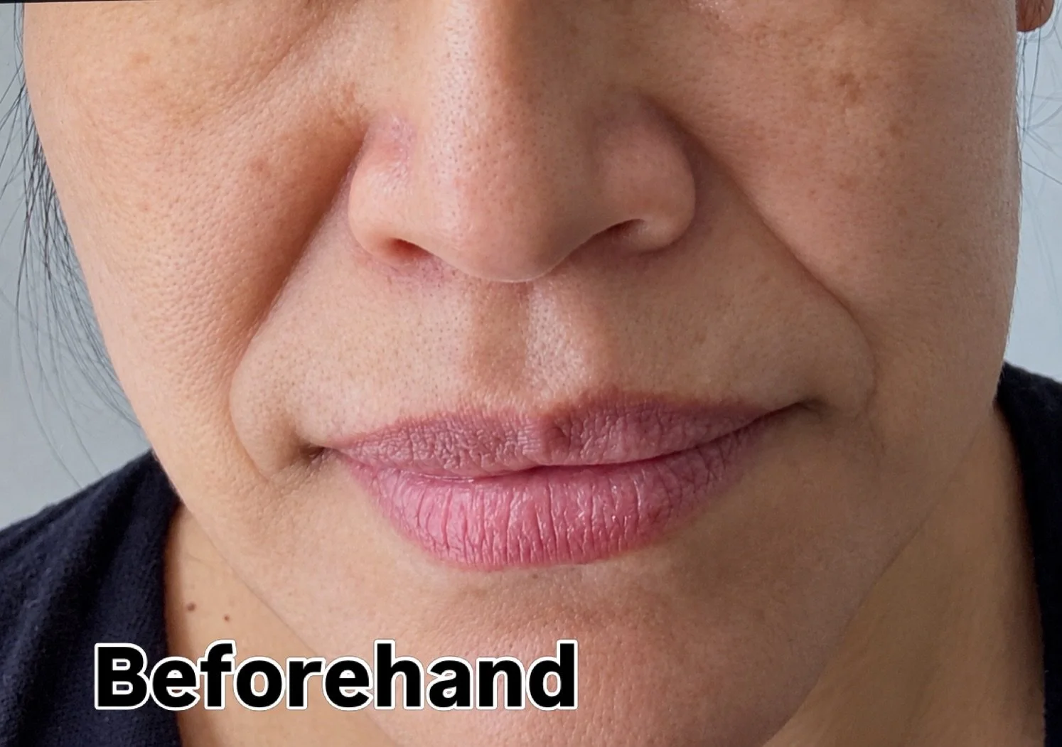 &ldquo;Why do I look unhappy when I&rsquo;m not?&rdquo; 👀

Sometimes, the lines below the corners of your mouth are telling a different story than you feel. 🤎

This before-and-after shows our client&rsquo;s marionette-line transformation&mdash;a so