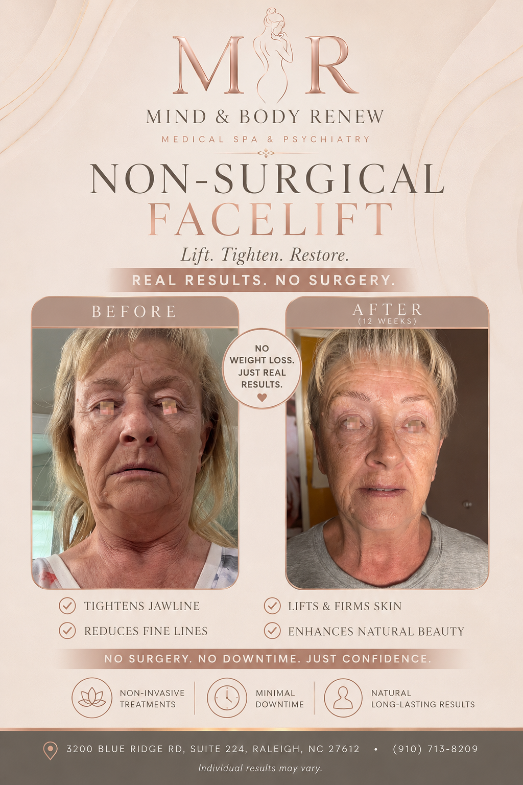 T shape II and Neveskin FACE & NECK, double chin in Raleigh nc