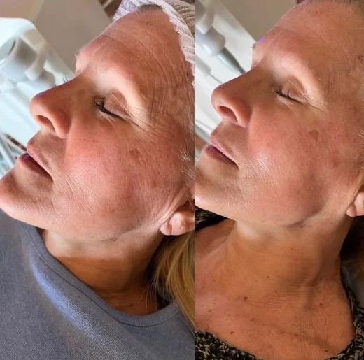 Close-up of a woman's face before and after a skincare treatment, showing improved skin texture and tone.