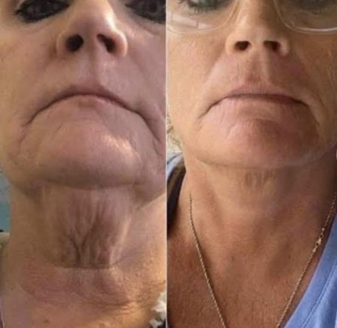Close-up of two women’s faces, showing before and after pictures of their chins and necks, highlighting a change in skin and chin appearance.