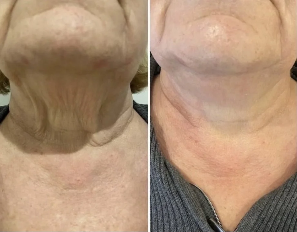Comparison of person's neck before and after skin treatment, showing reduced wrinkles and improved skin texture.