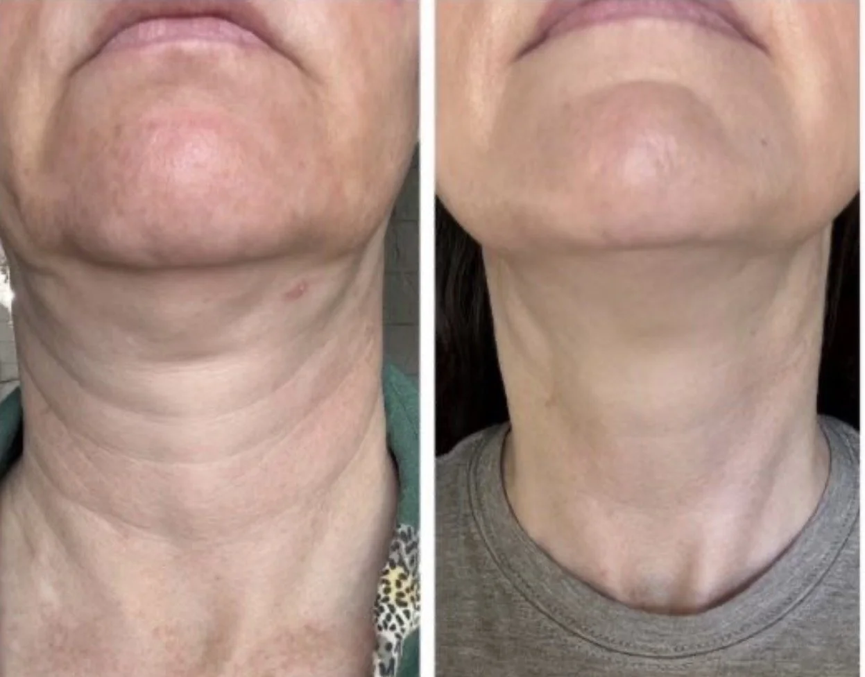 Comparison of a person's neck before and after skincare treatment, showing smoother, tighter skin on the right.