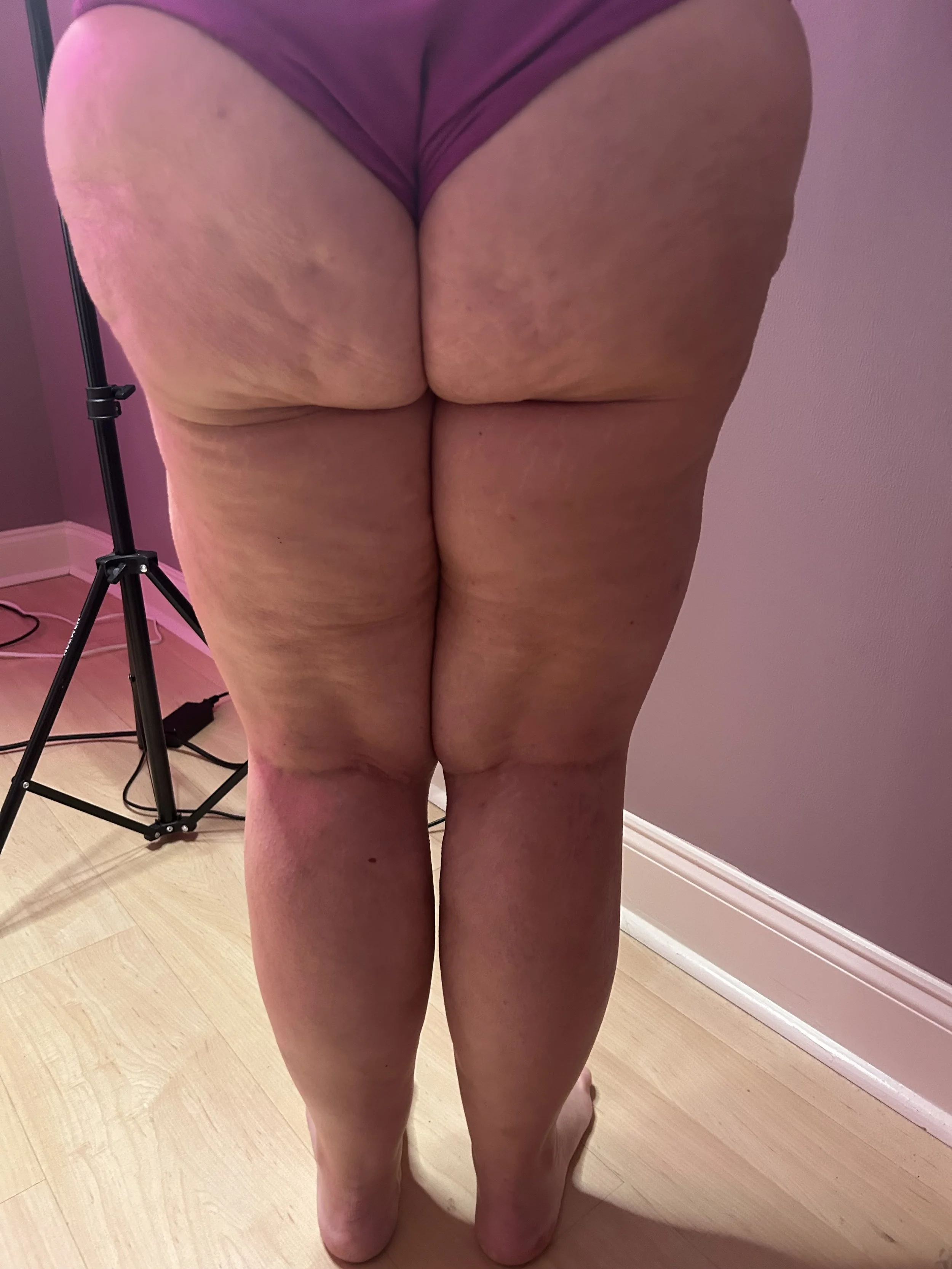 cellulite reduction