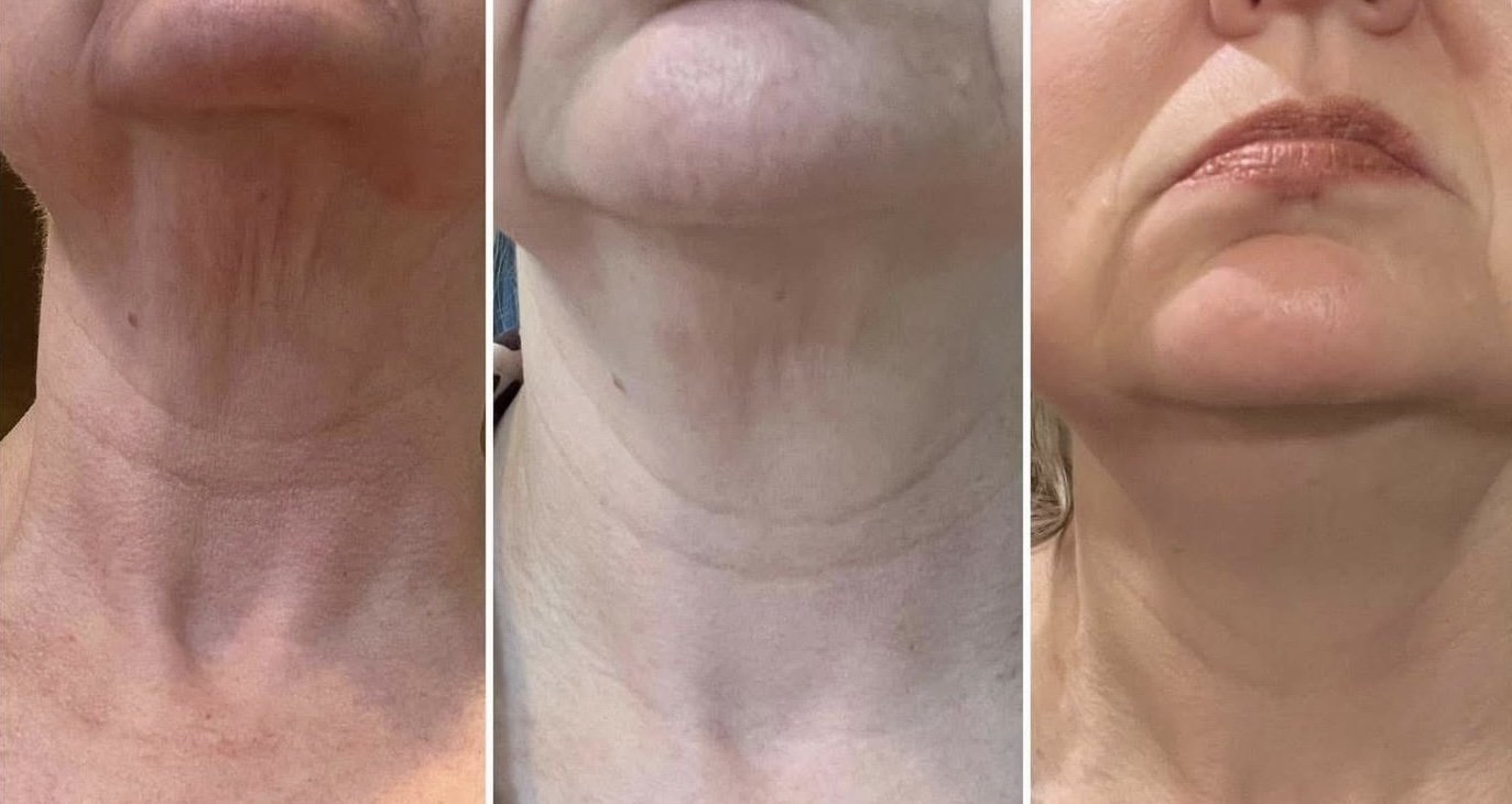 double chin reduction