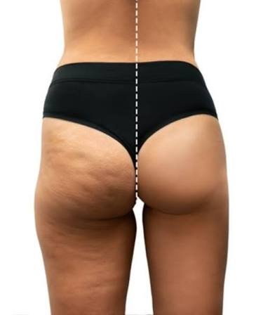 cellulite reduction