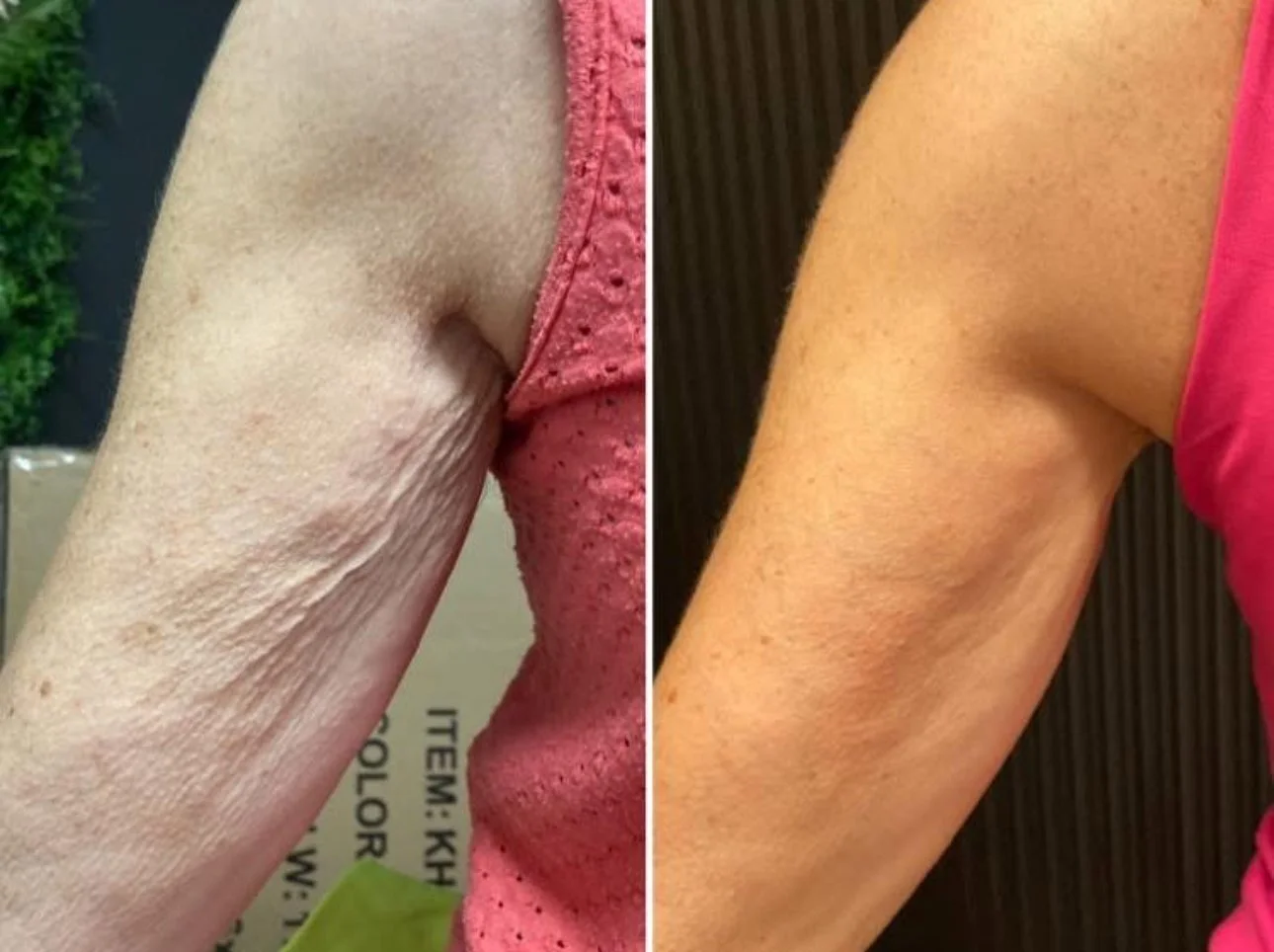 skin tightening 