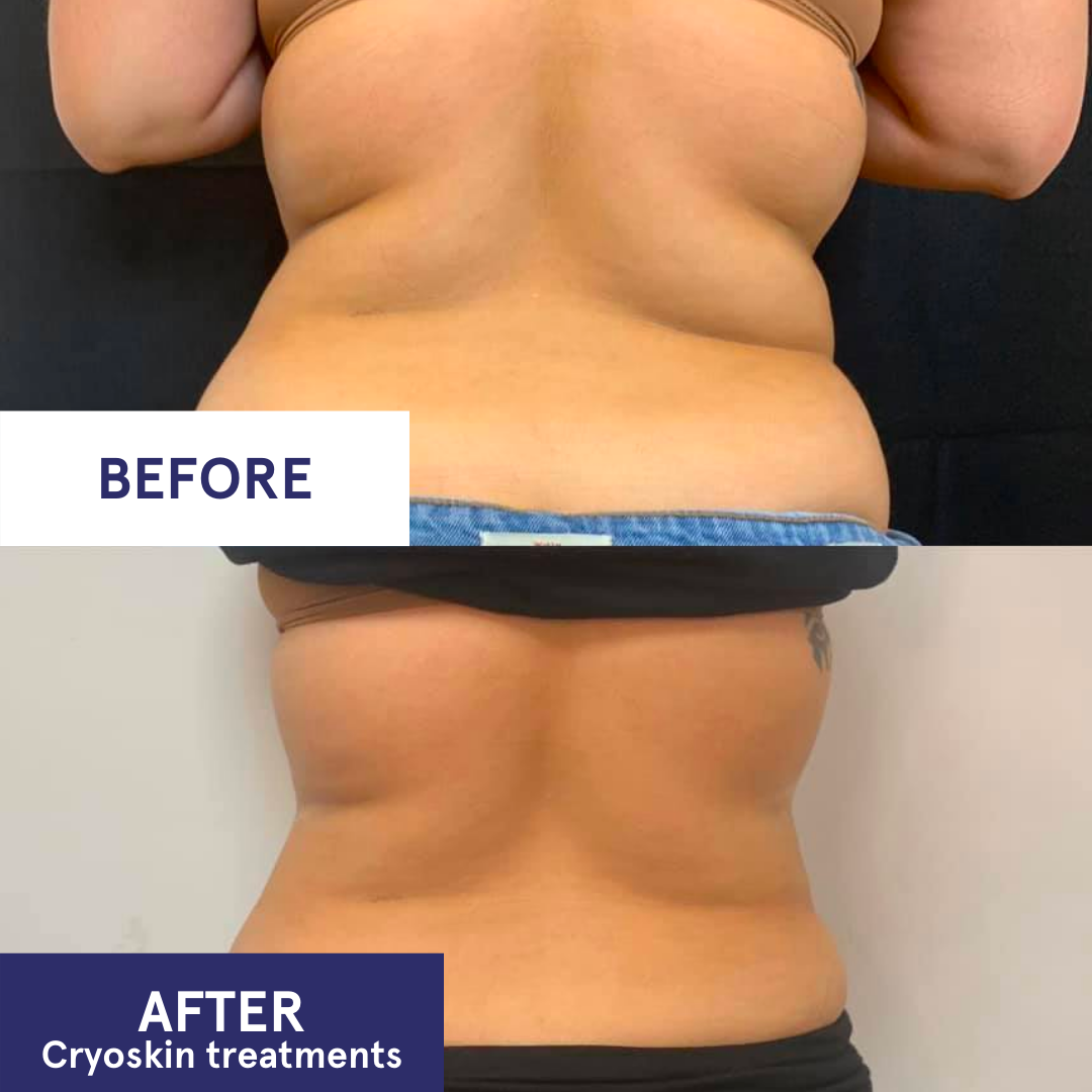 Comparison of a person's back before and after cryoskin treatments, showing reduction in fat and skin tightening.