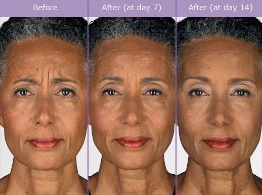 Per AREA Botox