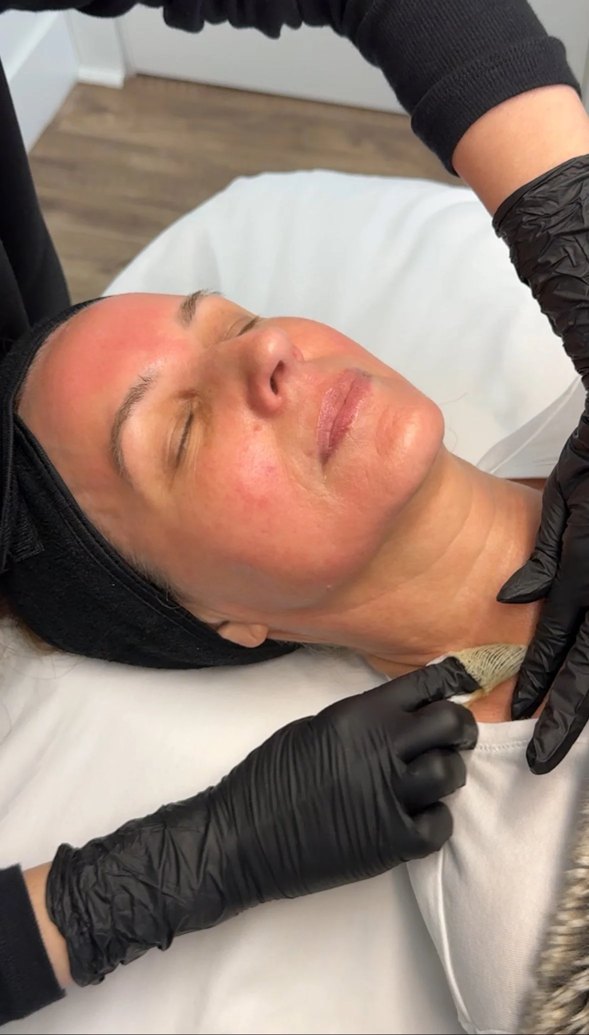 Perfect Derma Peel