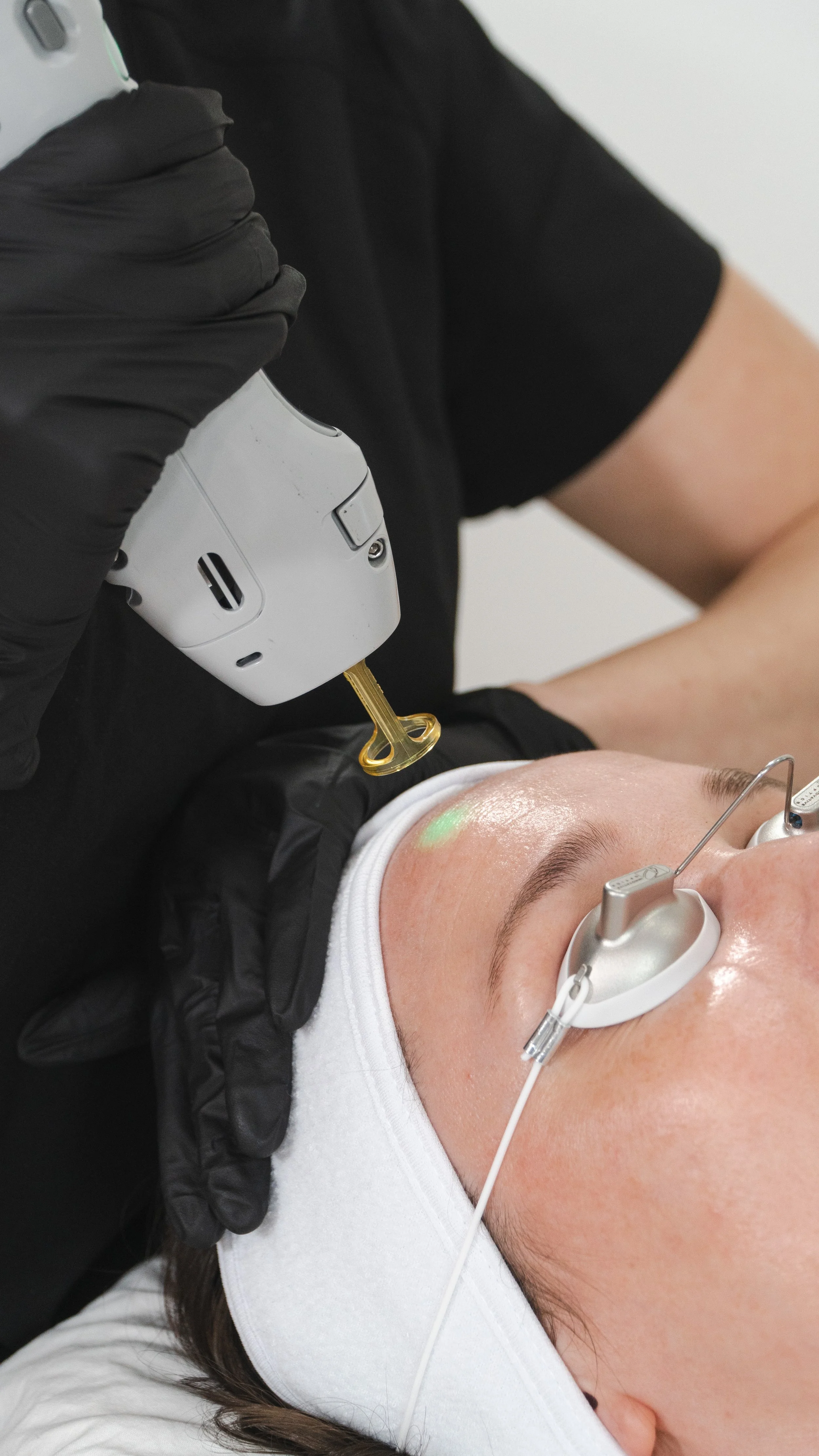 Client receiving Alexandrite laser treatment for sun spots and pigmentation using the Candela GentleMax Pro at Nude Skin & Laser in Langley, BC.