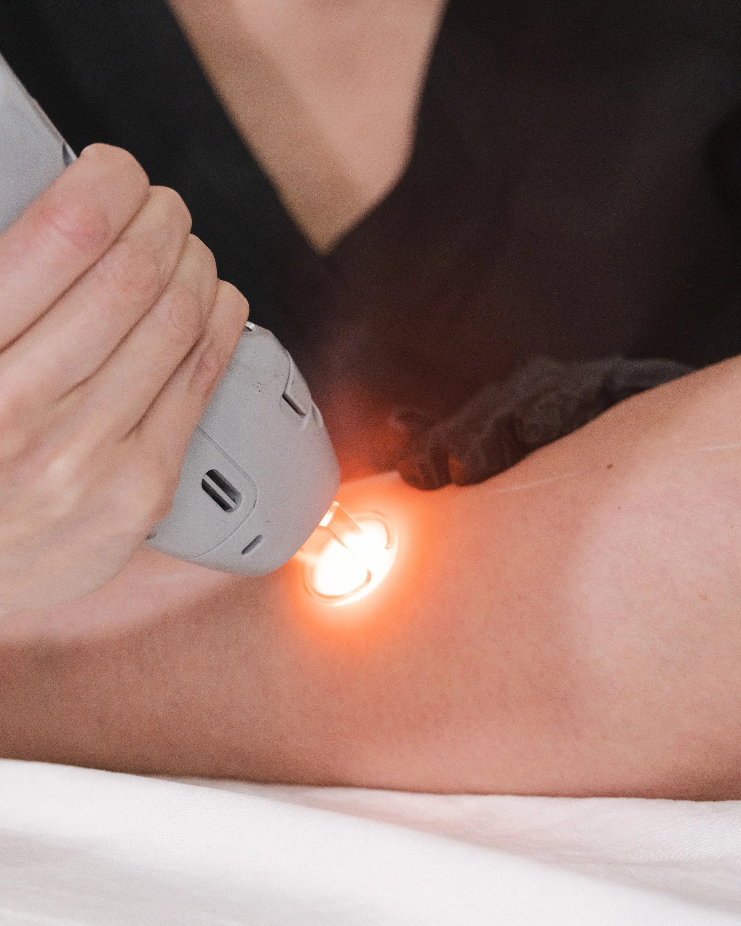 Laser hair removal treatment using the Candela GentleMax Pro at Nude Skin & Laser in Langley, BC with the laser beam visible during treatment.