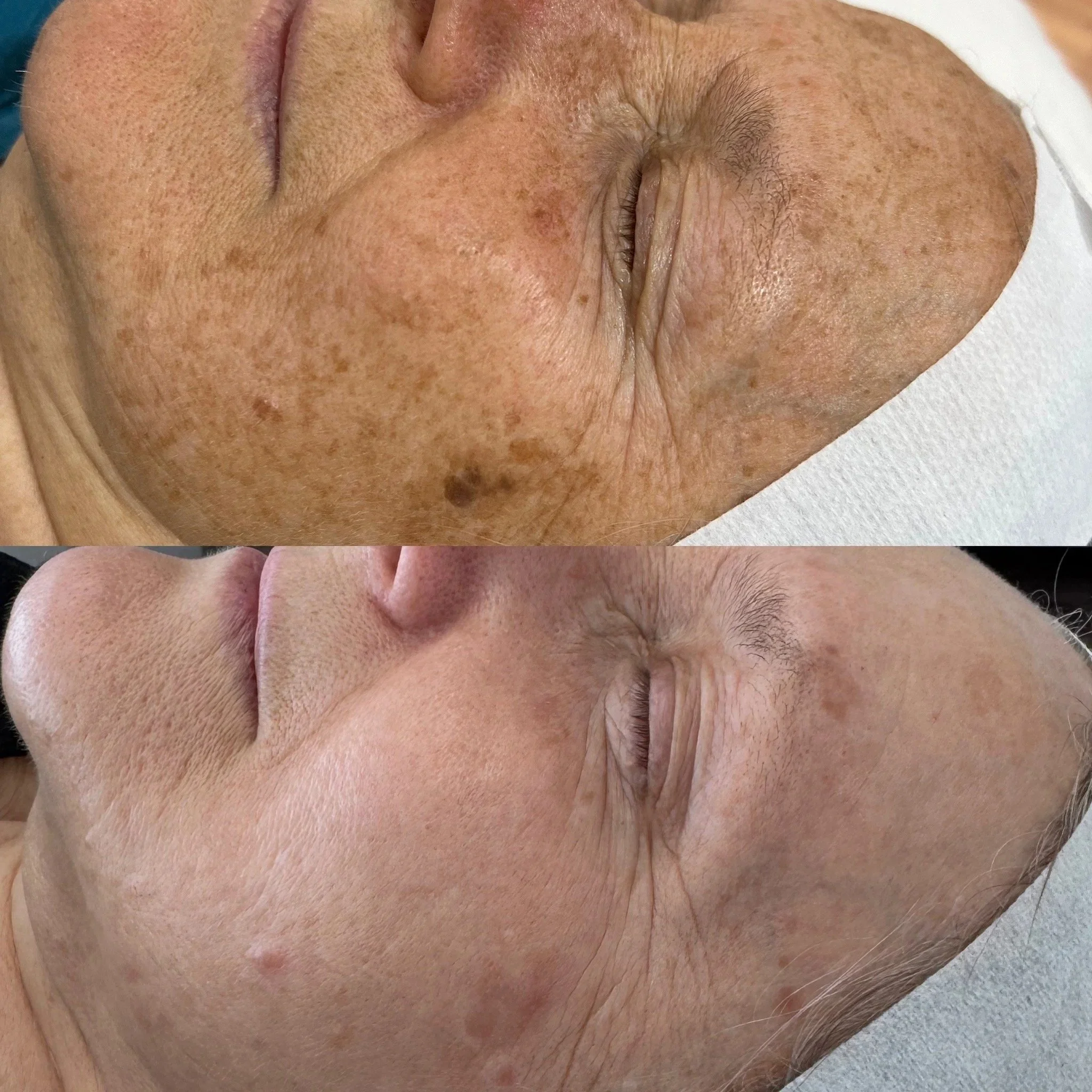 Before and after Alexandrite photo facial at Nude Skin & Laser in Langley, BC showing visible reduction in sun spots, age spots, and uneven pigmentation.