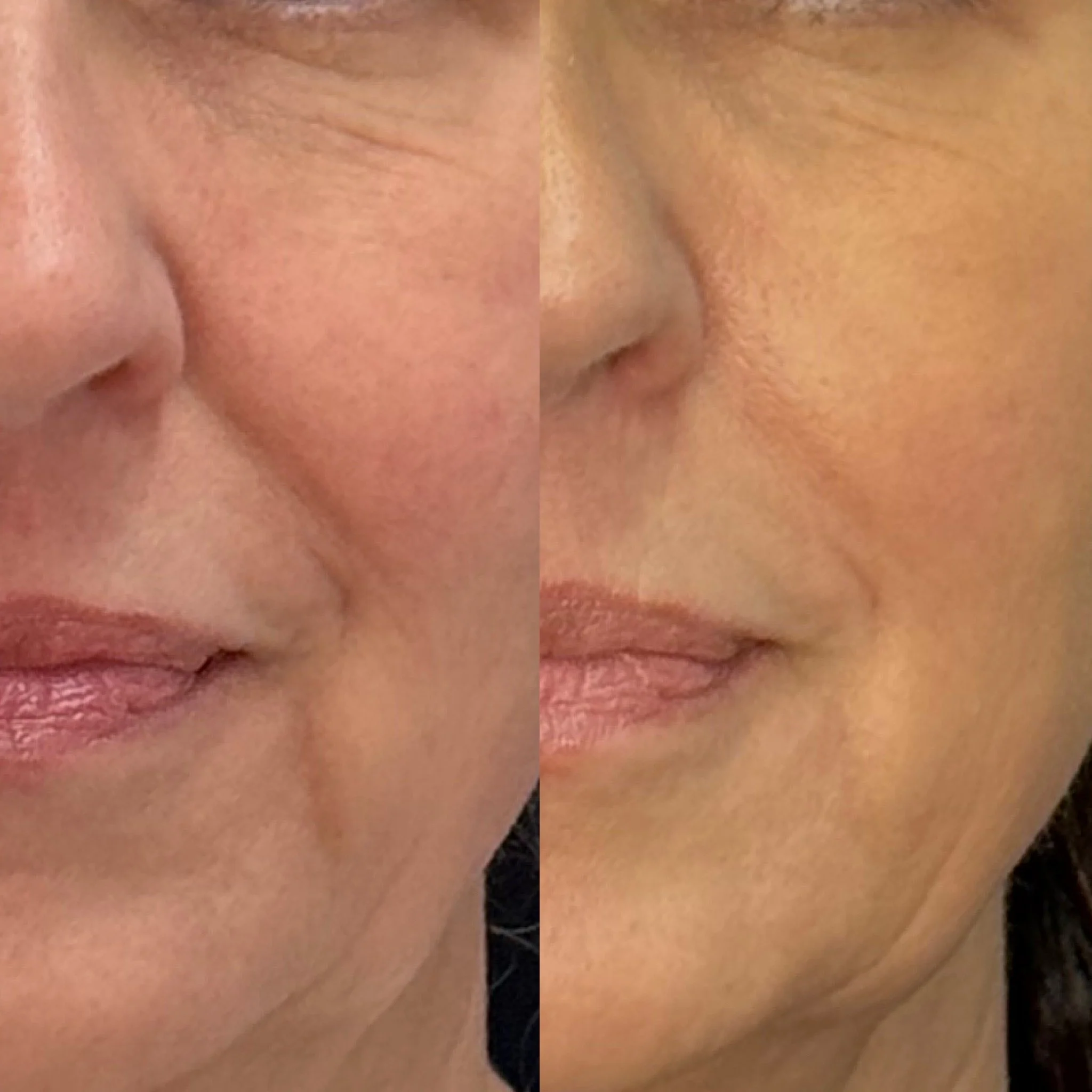 Before and after results of The Perfect Derma Peel at Nude Skin & Laser in Langley, BC showing improvement in pigmentation and overall skin tone.