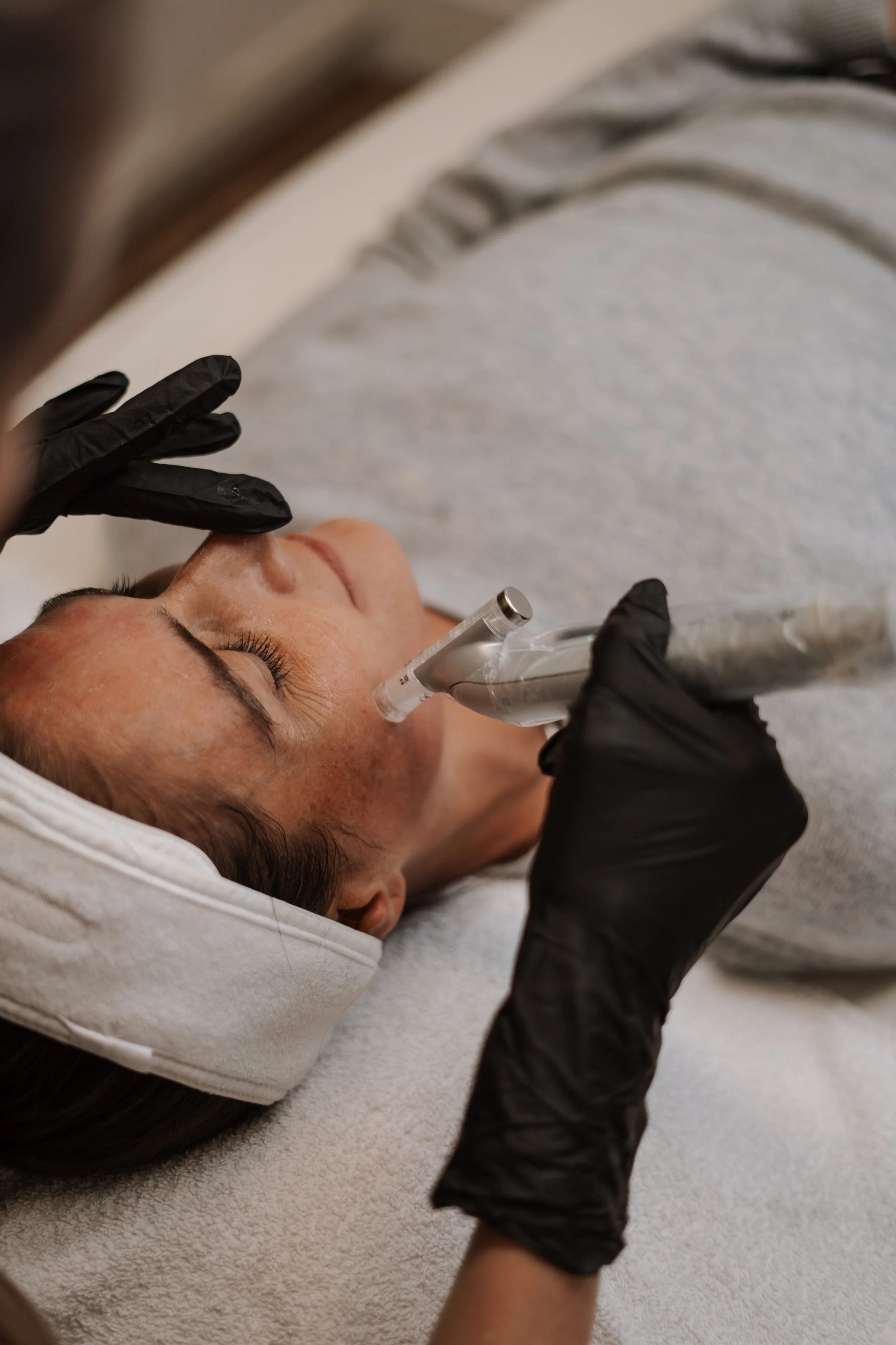 Client receiving EvoPen microneedling treatment at Nude Skin & Laser in Langley, BC to stimulate collagen, improve skin texture, and support skin rejuvenation.