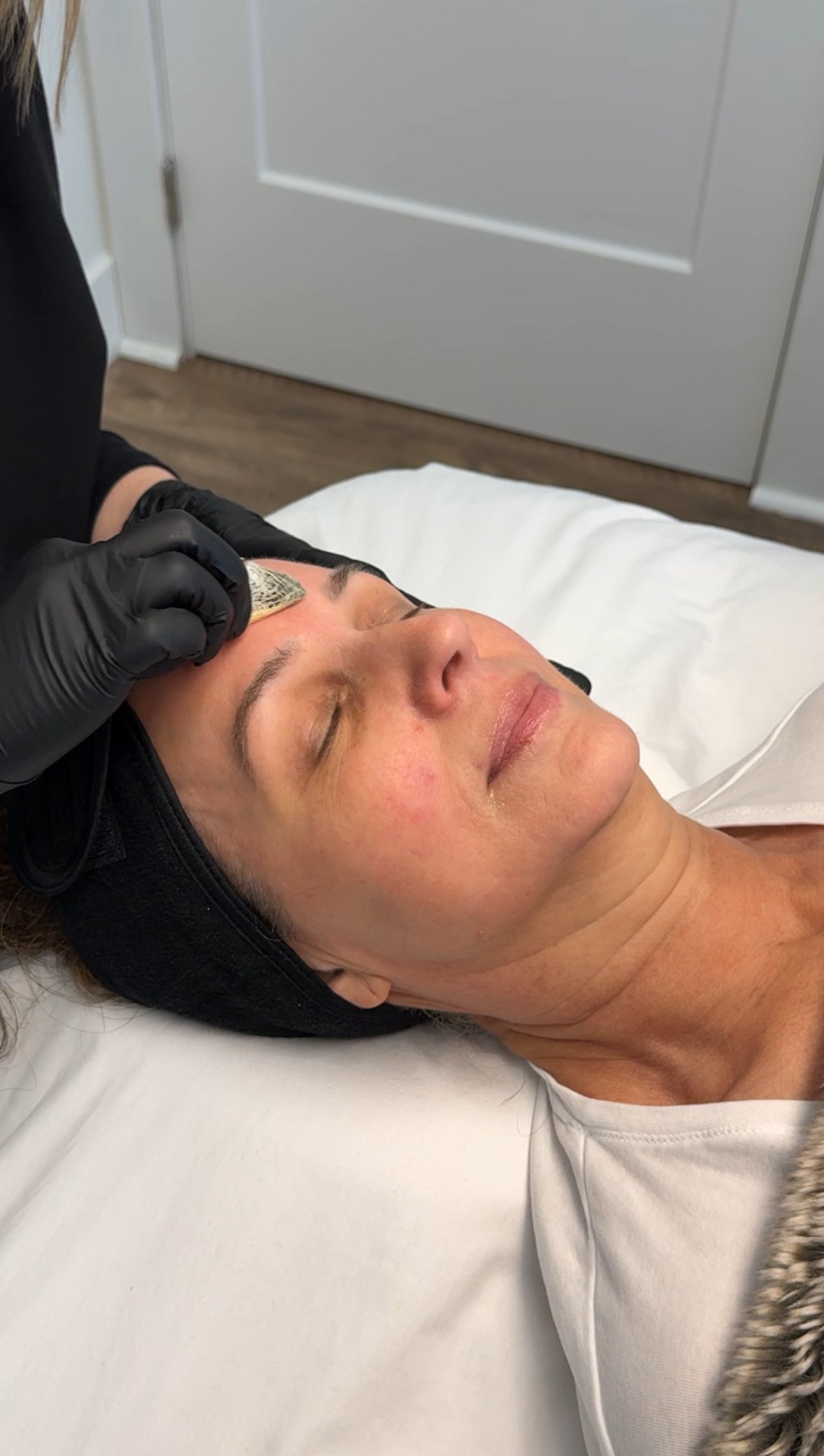 Application of The Perfect Derma Peel at Nude Skin & Laser in Langley, BC to improve skin tone, acne scars and sun damage.