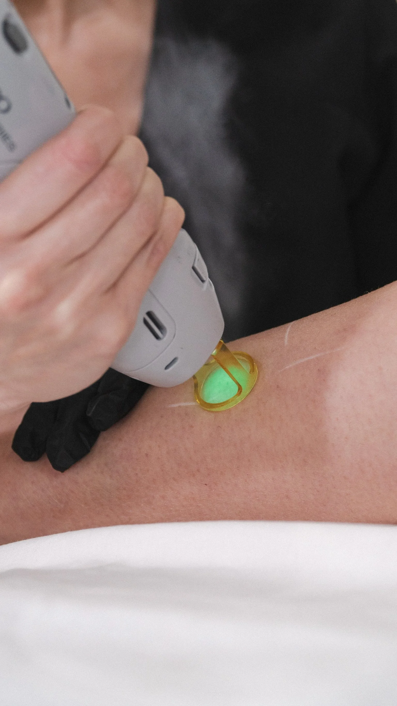 Laser Hair Reduction Consultation