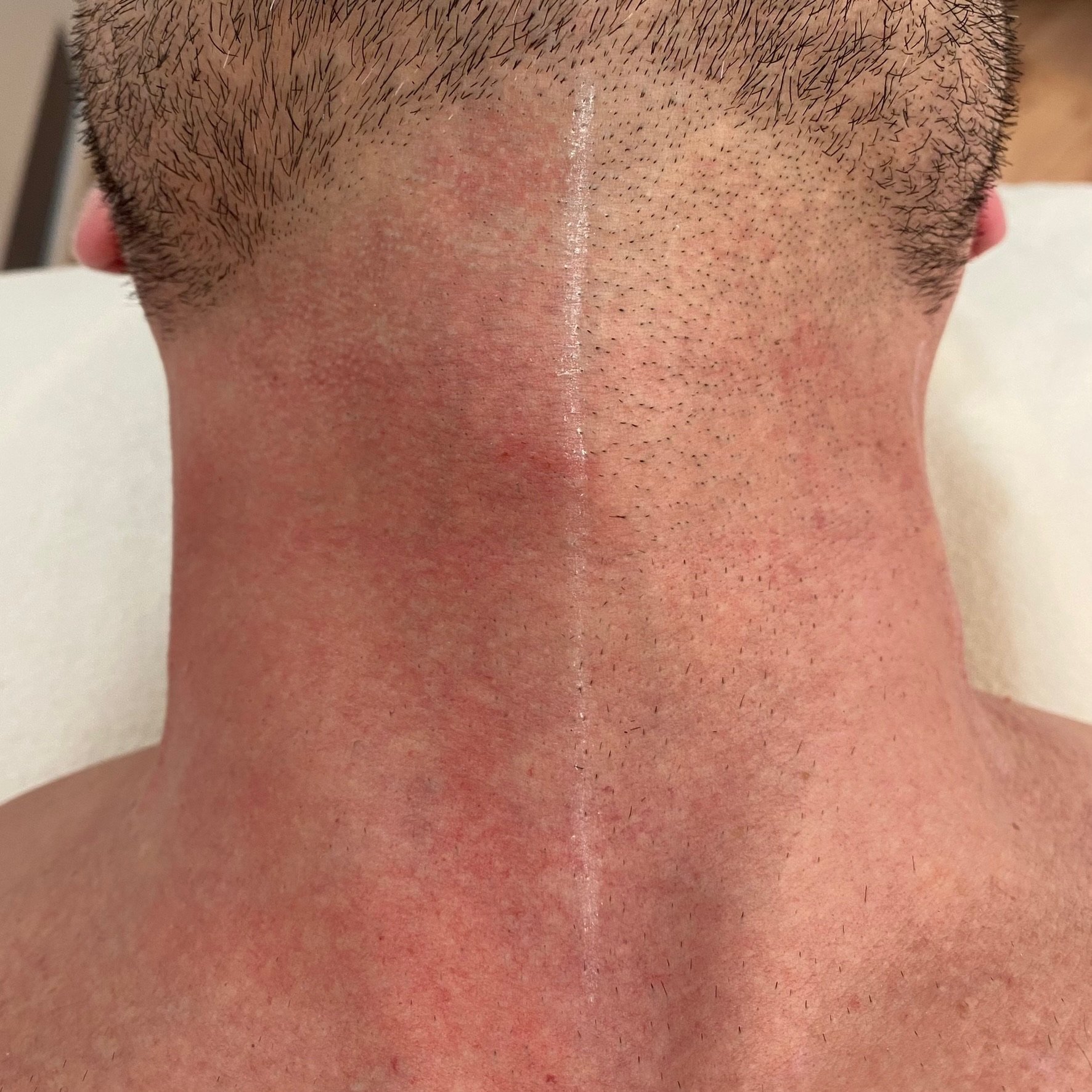 Side-by-side comparison of laser hair removal results on the neck at Nude Skin & Laser in Langley, BC showing treated and untreated areas with visibly reduced hair growth.