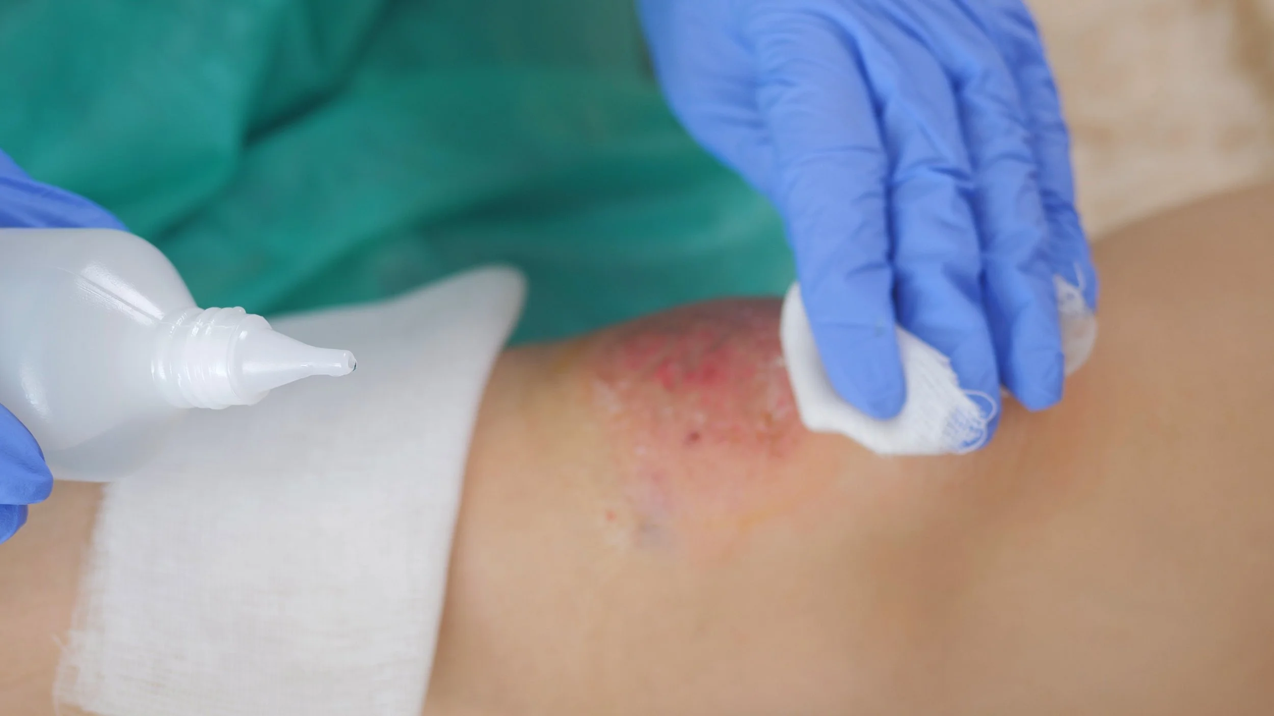 Unexplained Bruises in Nursing Homes: What They May Mean