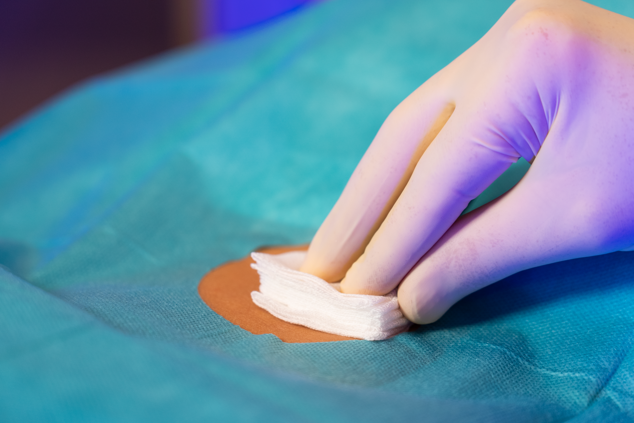 Eine Hand in einem medizinischen Handschuh, die Tupfer auf eine Wunde oder Operationsstelle auf einer blauen chirurgischen Abdeckung drückt.