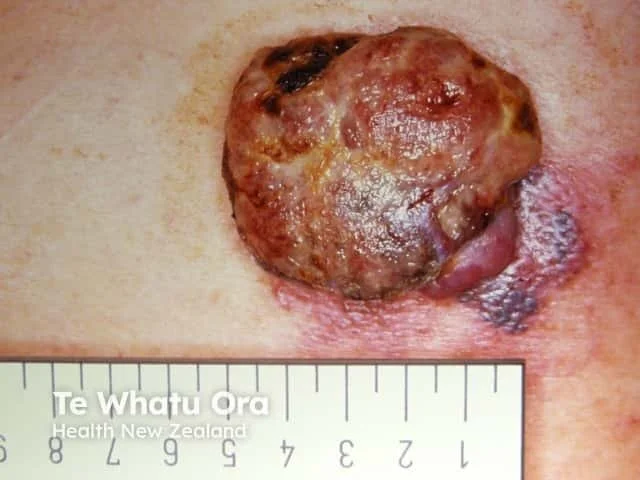 Close-up of a large, ulcerated skin lesion or wound with a measuring scale underneath.