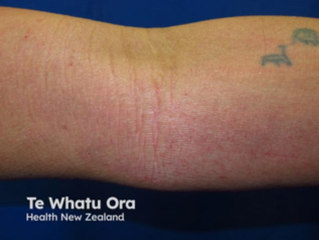 Close-up of a forearm with red stretch marks and a small tattoo, with text mentioning Te Whatu Ora and Health New Zealand.