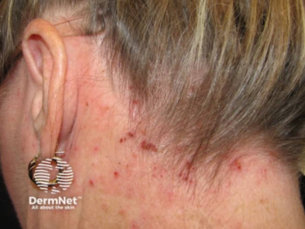 Close-up of a person's scalp and the area behind the ear, showing irritated skin with redness, small bumps, and scratches.