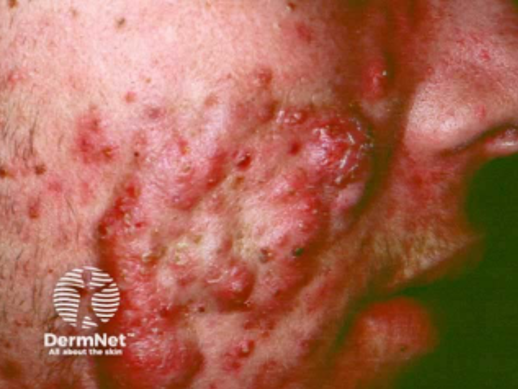 Close-up of inflamed, red skin with acne and pimples on a person's face.
