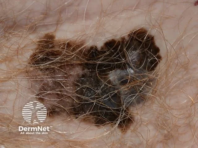Close-up of irritated skin with dark scaly patches and hair surrounding the area.