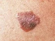 Close-up of a mole on skin