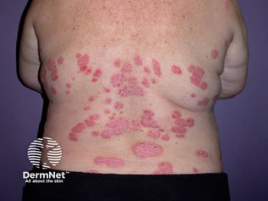 Close-up of a person's back with multiple red, scaly patches indicative of psoriasis.