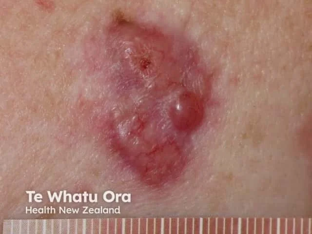 Close-up of a skin lesion on the face, appearing red, inflamed, with a blister and scabbing. Text overlay reads: "Te Whatu Ora, Health New Zealand."