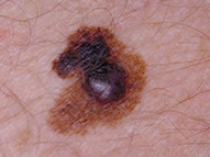 Close-up of a mole or skin lesion on skin.