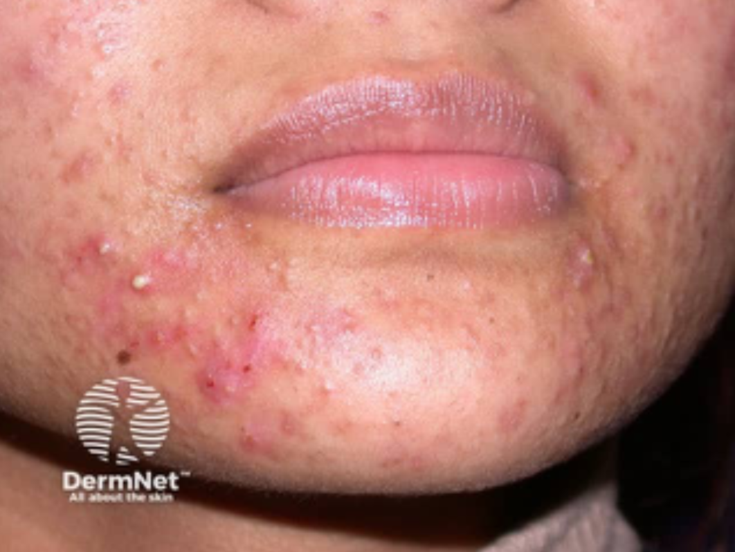 Close-up of a person's chin showing acne and skin irritation.