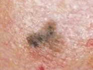 Close-up of skin with a dark mole or spot.