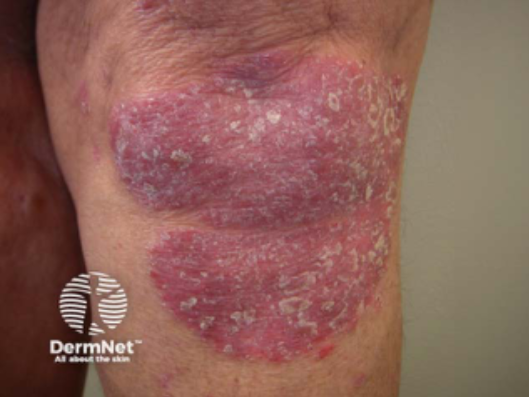 Close-up of a person's face with skin irritation, redness, dryness, and peeling.