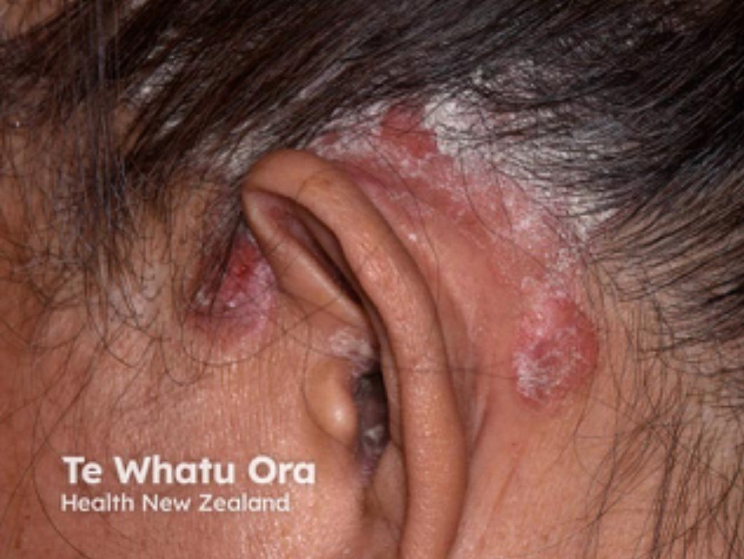 Close-up of a person's ear with red, scaly patches on the skin behind the ear. Text overlay reads 'Te Whatu Ora, Health New Zealand'.