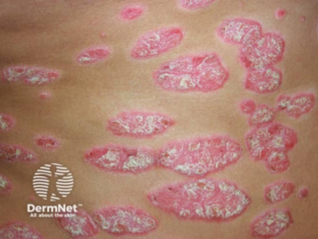 Close-up of skin with multiple scaly, red patches, indicating a dermatological condition.