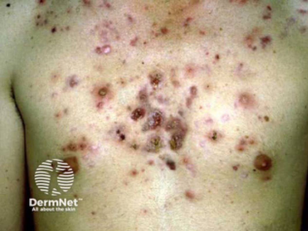 Close-up of a person's skin showing multiple clusters of small, dark, raised, and irritated skin lesions, possibly indicating a skin condition.