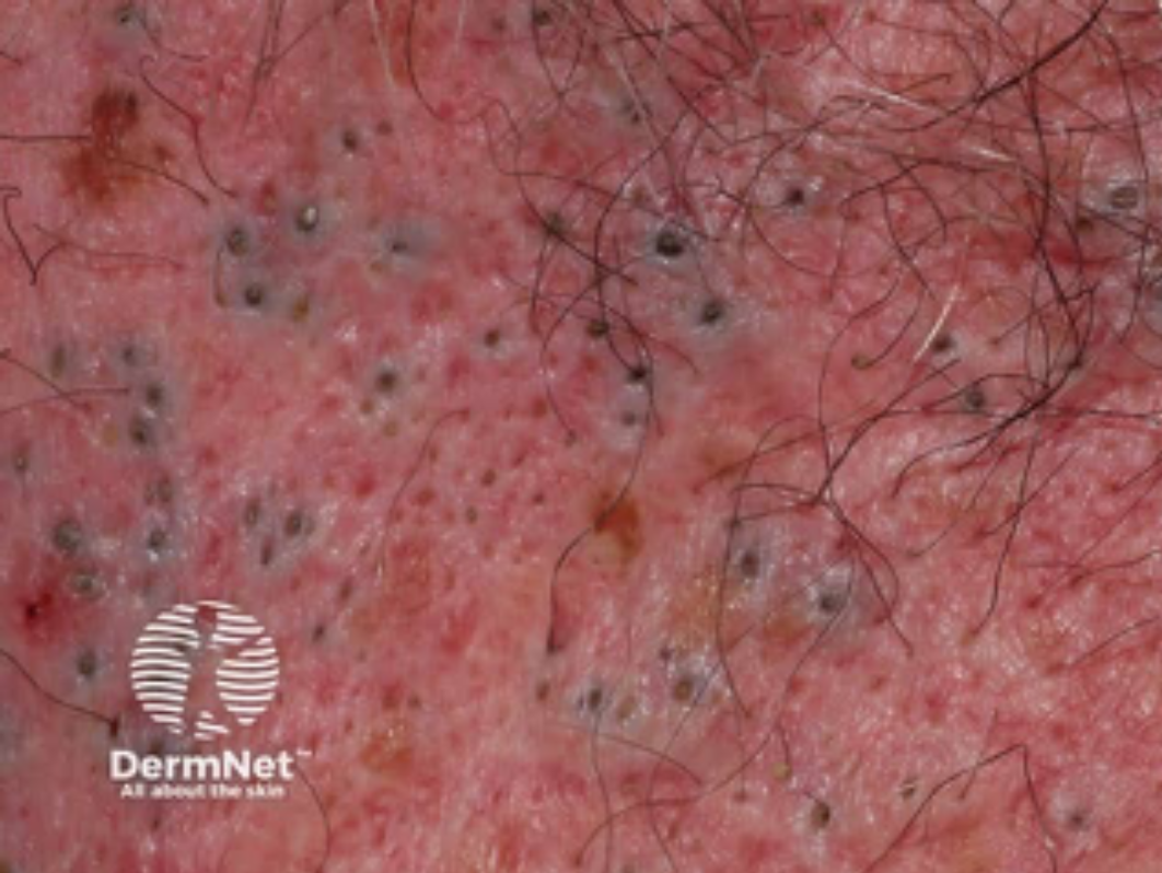 Close-up of skin with numerous small blackheads, redness, and hair follicles, highlighted with DermNet logo.