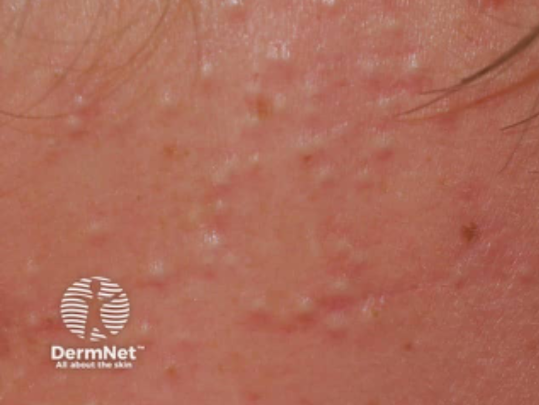 Close-up of human skin with acne and redness, featuring a DermNet watermark.