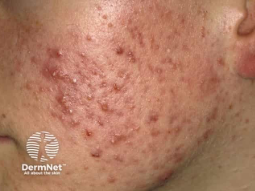Close-up of facial skin with active acne, redness, and inflammation, with visible pimples and pustules.