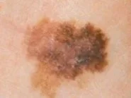 Close-up of a mole or skin lesion with uneven pigmentation and irregular borders