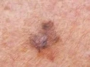 Close-up of a mole or skin lesion on human skin