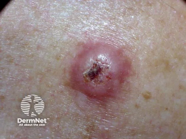Close-up of a skin ulcer with a black scab and surrounding redness, on human skin.