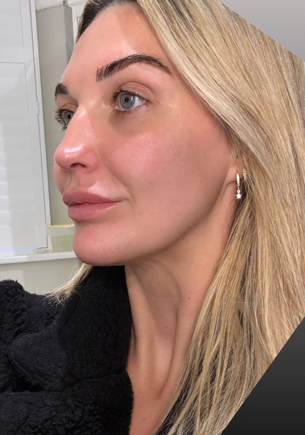 Subtle facial aesthetics results by expert practitioner Chloe in Poole