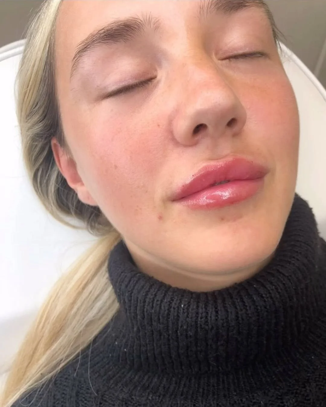 Expert-led anti-wrinkle injections in Poole by Aesthetics with Chloe