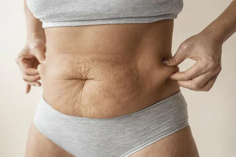 Bioregen Stretch Marks