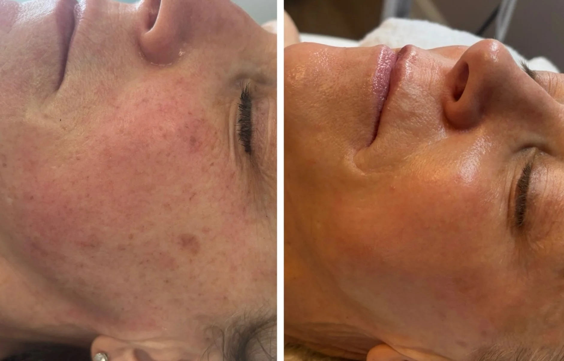 ✨ IPL SEASON IS FINALLY HERE! ✨

Summer may be over, but the sun damage it left behind doesn&rsquo;t have to stay. Charity is officially booking Lumecca IPL again at The Skin Bar! 🤎

What is Lumecca IPL? 💡

Lumecca uses powerful pulses of broad-spe